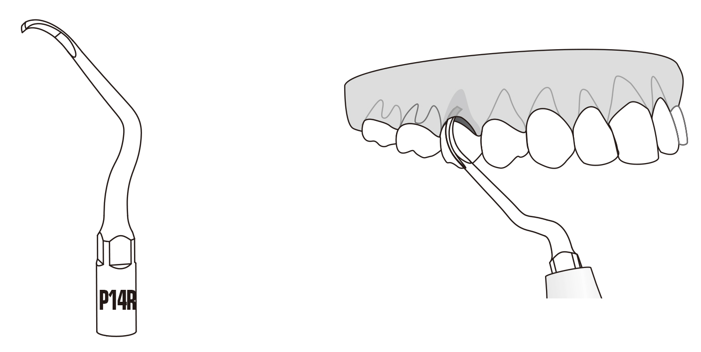 Сфера применения наконечника для скалера